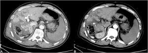 CT findings of portal vein thrombosis and large infarcts.