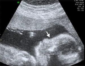 Sagittal section by ultrasound where showing the absence of the nasal bone.