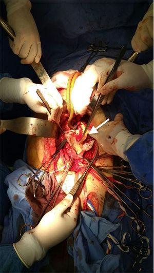 Transoperative photograph showing the opening of the aneurysmal sac and the dissection flap (arrow).