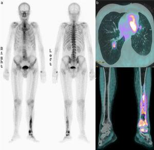 a) Gammagrafía ósea: depósitos patológicos de radiotrazador en la mitad inferior de la tibia, el peroné y el tarso izquierdos, indicativos de infiltración metastásica. b) PET-TC: captaciones hipermetabólicas a nivel de lóbulos pulmonares superior izquierdo e inferior derecho, segmento V-VI hepático, adenopatías en hilio hepático y retroperitoneales, captación en el tercio proximal de fémur derecho con múltiples focos hipercaptantes en la tibia, el peroné y los huesos del pie izquierdo, compatibles con metástasis.