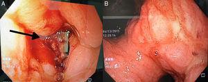 Tumor gástrico Bormann III, lesión a nivel del antro, ulcerada infiltrativa circunferencial, la cual estenosa antro y píloro.