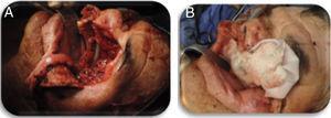 Fijación del obturador quirúrgico durante la cirugía oncológica. A) Exenteración con maxilectomía. B) Obturador quirúrgico. Fuente: Elaboración propia.