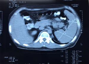 Tomografía computarizada de abdomen. Esplenomegalia.