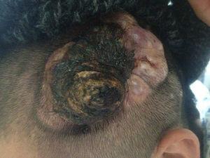 Tumor en cuero cabelludo, localizado en la región temporo-occipital izquierda.