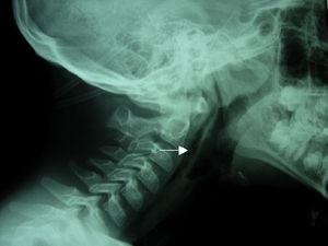 Radiografía de cuello que muestra enfisema subcutáneo (flecha).