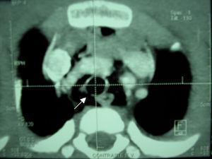 Tomografía computarizada de tórax que señala extenso neumomediastino y rotura de tráquea en su pared posterolateral derecha a nivel de T1-T2, que mide 1mm (flecha).