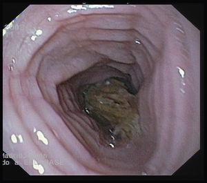 Traquealización esofágica. Impactación de bolo de carne en el esófago distal.