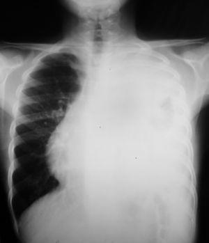 Radiografía de tórax: velamiento casi completo del hemitórax izquierdo, con área mínima del parénquima aireado y desviación traqueal contralateral.