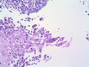 Fragmentos de mucosa escamosa esofágica que contienen células multinucleadas gigantes con núcleos amoldados y esmerilados que sugieren infección herpética (H-E ×40).