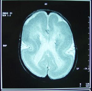 Resonancia magnética cerebral, corte axial T2, donde se aprecia córtex liso, engrosado, con una capa fina de sustancia blanca, ventrículos discretamente dilatados e hipogenesia del cuerpo calloso, con ausencia de esplenio y rostrum.