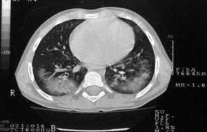 Tomografía computarizada torácica: infiltrados alveolares difusos.