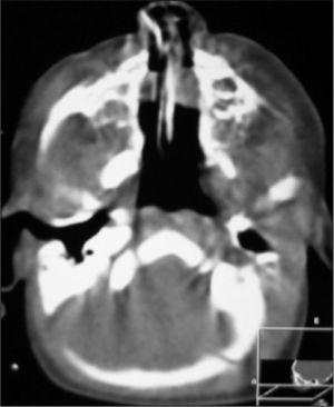 Tomografía computarizada: masa de baja densidad bilateral intranasal, más marcada en el lado izquierdo.