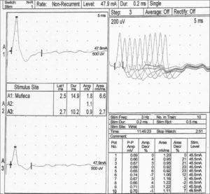 Estudio del nervio cubital derecho. En el canal A1 se registra el potencial de acción motor compuesto (CMAP) pasados 10min de la tetanización. El incremento tan significativo de la amplitud y el área (> 100 %), con respecto al valor basal previo (canal A3), mostró facilitación posactivación. La parte derecha de la gráfica indicó decremento del área del cuarta potencial de acción durante la estimulación repetitiva de baja frecuencia.