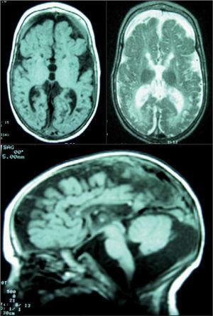 RM craneal. Se observa hipolasia casi completa del cuerpo calloso, marcada dilatación atrófica del sistema ventricular, atrofia cortical y central y un llamativo aumento del espacio extraaxial. Afectación completa de la mielina. Hipoplasia cerebelosa. Atrofia particular de los temporales con gran aumento de las cisternas subaracnoideas. No se identifican los principales ganglios de la base. Aspecto neurorradiológico de cerebro "en nuez".