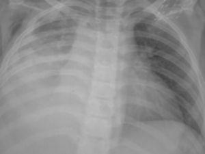 Radiografía posteroanterior de tórax: atelectasia masiva del pulmón derecho.