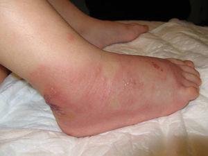 Lesiones eritematoedematosas, levemente violáceas, con algunas vesículas.