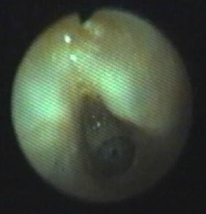 Imagen de estenosis subglótica de un niño con dificultad para la extubación.