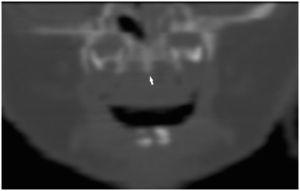 Estenosis Congénita Del Orificio Piriforme | Anales De Pediatría