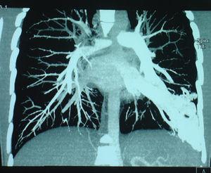 Tomografía computarizada pulmonar. Fístula arteriovenosa en el lóbulo inferior izquierdo.