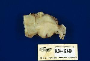 é uma lesão de aparência polipóide de cerca de 6 cm de diâmetro, com coloração de pardoval, revestida com mucosa normal e com uma certa ulceração em sua superfície.