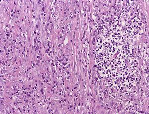 tumeur Fusocellular origine dans la séreuse intestinale, constitué par des faisceaux de fibres Avec une cellule très polymorphe, où les éléments inflammatoires et les cellules de myofibroblaste alternent.