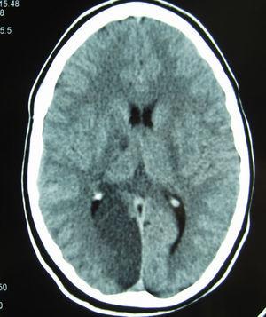TAC craneal: infarto en el territorio de la arteria cerebral posterior derecha y en el tálamo derecho.