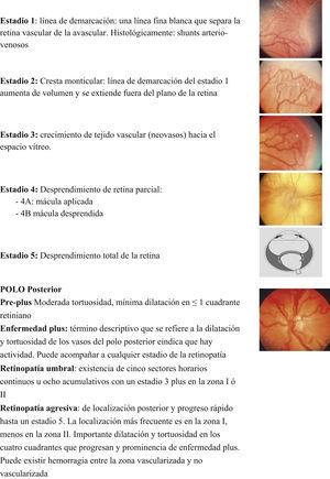 Estadios y definiciones de las diferentes situaciones clínicas de la retinopatía de la prematuridad.