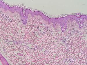 Biopsia de angiofibroma donde se observa leve atrofia, aumento de las fibras de colágena dérmica y proliferación capilar dérmica (hematoxilina y eosina 10×).