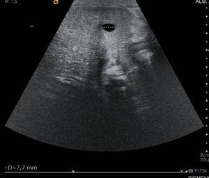 Imagen quística dependiente de la vía biliar intrahepática bien delimitada de unos 7mm en el segmento V.
