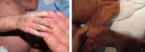 Lesiones verrugosas en el tercer y cuarto dedo de la mano derecha y lesiones hiperpigmentadas en extremidad inferior.