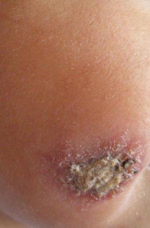 Lesión costrosa en la mejilla derecha, caliente e indurada, con bordes eritematosos.