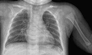 Radiografía de tórax de lactante de 6 meses con hipocalcemia, secundaria a raquitismo. Se observa una osteoporosis generalizada y un ensanchamiento de la metáfisis proximal del húmero.