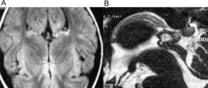 Imágenes de la resonancia magnética cerebral del caso 2. A) Corte axial con imagen de quiste de la glándula pineal. B) Corte sagital a mayor aumento, con medición del quiste de la glándula pineal.
