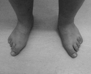 Deformidades de los dedos de los pies por acortamiento de los metatarsianos.