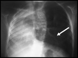 Radiografía de tórax a los 6 años de edad que muestra una dextrocardiaca con desplazamiento del mediastino a la derecha, hipoplasia del pulmón derecho e hiperinsuflación compensatoria del pulmón izquierdo. No se aprecia ningún colector venoso. Se visualizan el istmo y la fisura ístmica (flecha).