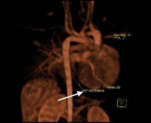 Angiorresonancia magnética en 3 dimensiones: en la aorta torácica descendente tiene origen una arteria sistémica que irriga el lóbulo inferior del pulmón derecho (flecha).
