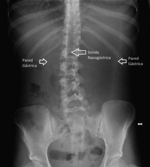 Radiografía inicial de abdomen con gran dilatación gástrica y límite inferior de estómago en región pélvica.