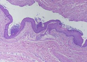 Cavidad central parcialmente colapsada, tapizada en su parte inferior por epitelio («color azul») que se pierde en la parte superior debido a la ulceración. En el centro de la imagen se aprecia una glándula sebácea en el conjuntivo subyacente al epitelio.