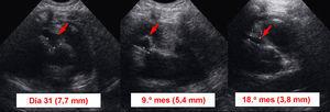 Evolución ecocardiográfica del aneurisma de la coronaria derecha durante el seguimiento. La flecha roja indica el aneurisma en su diámetro máximo.