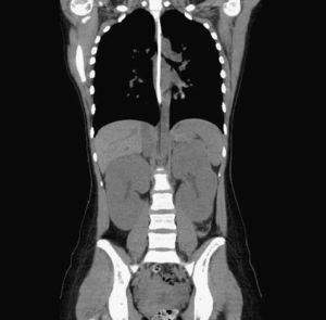 TC abdominal en el que se aprecia aumento de tamaño de ambos riñones sin hidronefrosis ni afectación de otros órganos ni nódulos linfáticos.