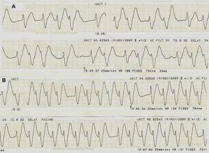 A) Trazado de monitorización (DII) inicial con ritmo de la unión, QRS 200ms, QTc 512ms. B) Trazado electrocardiográfico durante la taquicardia ventricular.