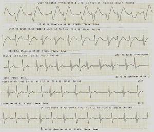 Evolución electrocardiográfica del paciente. Nótese el estrechamiento progresivo del QRS según el transcurso horario, con ritmo inicial de la unión hasta la restauración final del ritmo sinusal 12h después de iniciado el tratamiento. Mediciones finales PR 160ms, QRS 100ms, QTc 485ms.