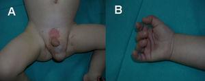 Rasgos dismórficos. A) Criptorquidia bilateral y hernia inguinal izquierda. B) Surcos palmares profundos. Clinodactilia.