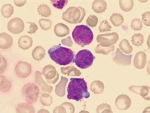 Microfotografía de la extensión de sangre periférica de un paciente diagnosticado de mielopoiesis anormal transitoria. Identificación de blastos mieloides mediante citología convencional (tinción May-Grunwald-Giemsa).