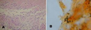A) Biopsia de costilla caso 1. Se observa granuloma necrosante con empalizada de histiocitos (H-E 400×). B) Coloración de plata de Whartin–Starry: se observan bacilos fragmentados y deformados (900×).