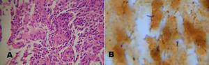A) Biopsia de vértebra caso 2. Se observa infiltrado inflamatorio mixto y restos celulares (H-E 600×). B) Coloración de plata de Whartin–Starry: se observan bacilos bien definidos (900×).