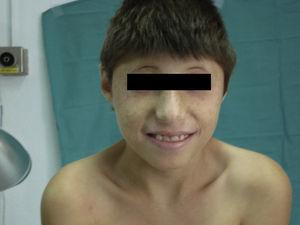 Características faciales del paciente típicas del síndrome de Nijmegen. Se observan efélides.