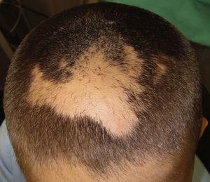 Área de alopecia con bordes irregulares y pelos sanos cortados a distintas longitudes en su interior (caso 1).