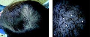 A) Región parieto-occipital con alopecia difusa (caso 2). B) Visión dermatoscópica del caso 2 en la que se observan pelos cortados a distintas longitudes (flechas).