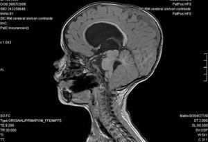 RM cerebral: dilatación ventricular tetracameral, descenso de amígdalas cerebelosas, hipoplasia hipofisaria con ausencia de tallo y neurohipófisis ectópica.